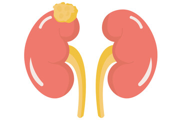 Kidney cancer starts in the kidneys. Similar diseases include renal cell carcinoma, Wilms tumor, and transitional cell carcinoma. It affects kidney function and may spread,red
