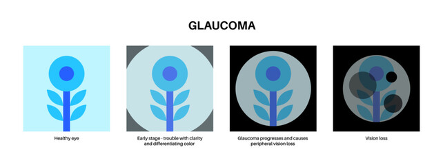 Glaucoma eye disease