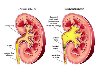 Medical illustration comparing a normal kidney to one affected by hydronephrosis with annotations explaining the symptoms and one possible cause.