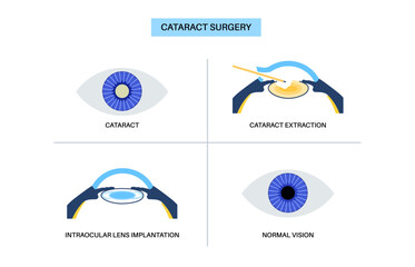 Cataract surgery poster