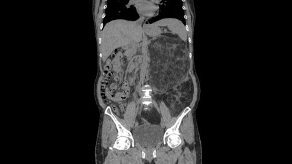 Abdomen liposarcoma, CT scan