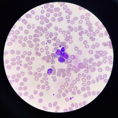 Abnormal blood cell