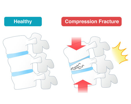 Mechanism of spinal compression fracture due to osteoporosis seen from the side
