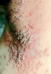 Fototapeta premium A Close up view of women with shingles (herpes zoster) disease on skin and he feel very painful