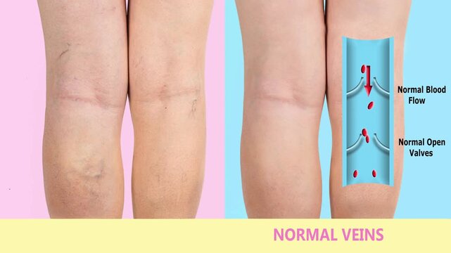 Varicose veins on a female senior legs. The structure of normal and varicose veins. Concept of dry skin, old senior people, varicose veins and deep vein thrombosis or DVT - 2D animation