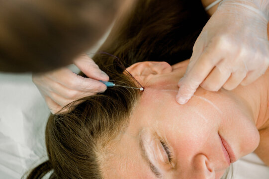 Cosmetic procedure with hyaluronic acid and tensor threads