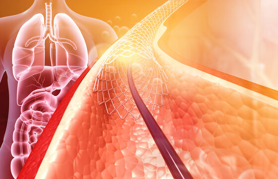 Stent implantation concept. 3d illustration