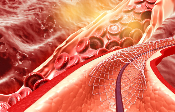 Stent implantation concept. 3d illustration
