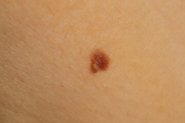 Woman with mole on her skin, closeup