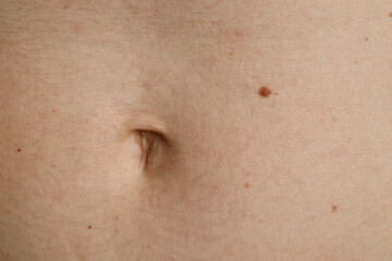 Fototapeta premium Woman with birthmark on her skin, closeup