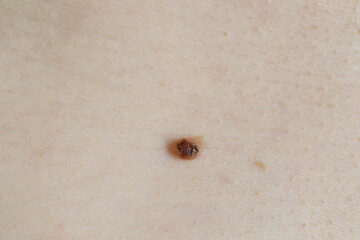 Man with birthmark on his skin, closeup