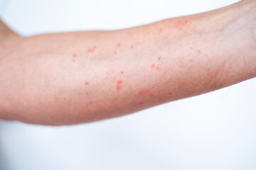 male hand with red skin rash, itchy skin, allergic response, Hives, chronic Psoriasis, Drug eruption, Contact dermatitis