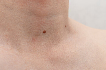 Large mole on the neck