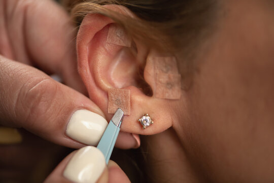 Acupuncturist stimulating auricular acupuncture points for treating anxiety