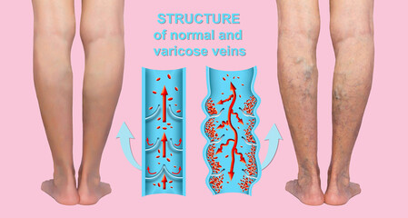Varicose veins on a female senior legs. The structure of normal and varicose veins.