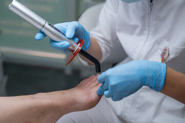 Рodologist in gloves puts a titanium thread on a toenail with special polymerization ultraviolet...
