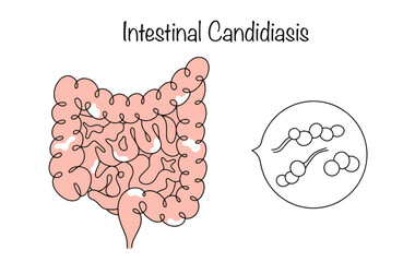 Intestinal Candidiasis