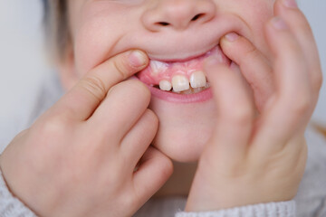 Young Smiling child, boy, age 10 reveals growing teeth, marking milestone in dental development, showcasing white healthy teeth, oral hygiene