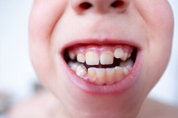 close-up teeth of child, boy 10 years old new tooth fang in mouth with finger, concept children's...