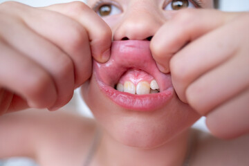 close-up teeth of child, boy 10 years old points new tooth fang in mouth with finger, concept...