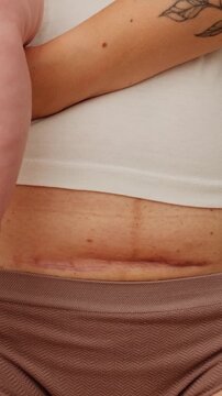 Woman belly with a scar from cesarean section with newborn baby's legs. Dolly shot of the abdomen with c-section scar. Cropped view of a mother holding baby showing a real body. Postpartum recovery.