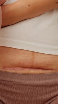 Woman belly with a scar from cesarean section with newborn baby's legs. Dolly shot of the abdomen with c-section scar. Cropped view of a mother holding baby showing a real body. Postpartum recovery.