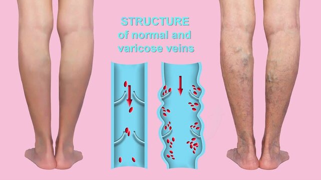 Varicose veins on a female senior legs. The structure of normal and varicose veins. Concept of dry skin, old senior people, varicose veins and deep vein thrombosis or DVT - 2D animation