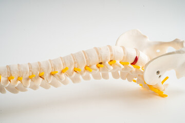 Fototapeta premium Lumbar spine displaced herniated disc fragment, spinal nerve and bone. Model for treatment medical in the orthopedic department.