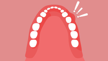 Oral Cancer, flat color illustration