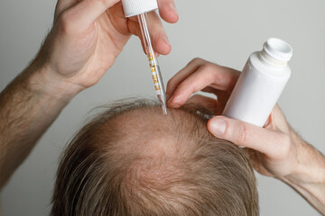 Close-up of male baldness treatment. Anti hair loss clinic serum. Nature hair care procedure. Male...