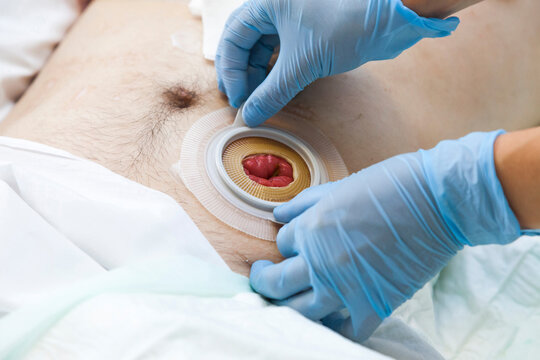 Close up stoma and colostomy after colon cancer surgery out. Cover stoma with one piece colostomy bag sticking, stoma patient care