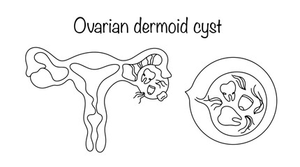 Obraz premium Ovarian dermoid cyst