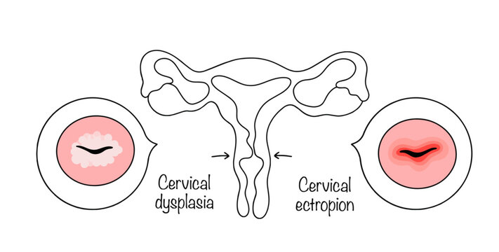 Pathologies of the cervix