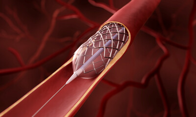 Angioplasty, Stent insertion 3d illustration