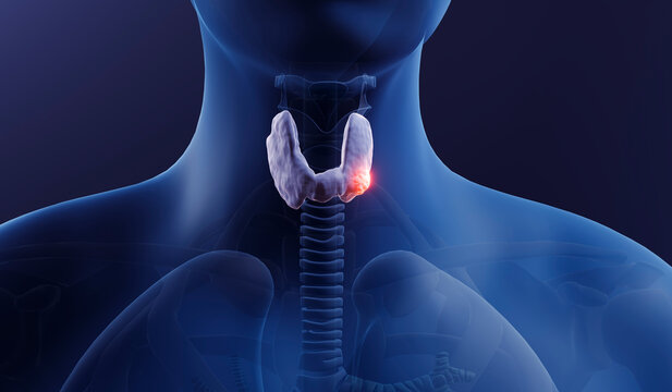 Thyroid gland cancer