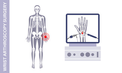 Wrist arthroscopy surgery