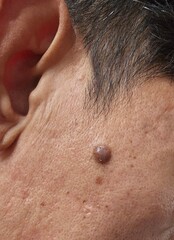 Fototapeta premium A mole on the face seen up close that enlarges and grows hairs