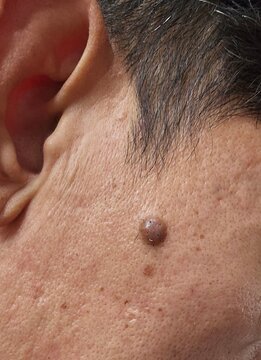 A mole on the face seen up close that enlarges and grows hairs