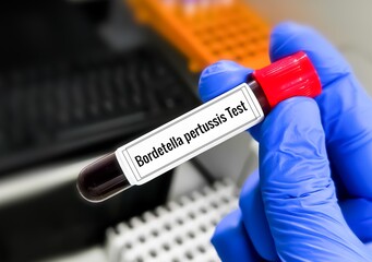 Bordetella pertussis test. Bordetella pertussis is a bacterium causing whooping cough