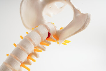 Spinal nerve and bone, Lumbar spine displaced herniated disc fragment, Model for treatment medical in the orthopedic department.