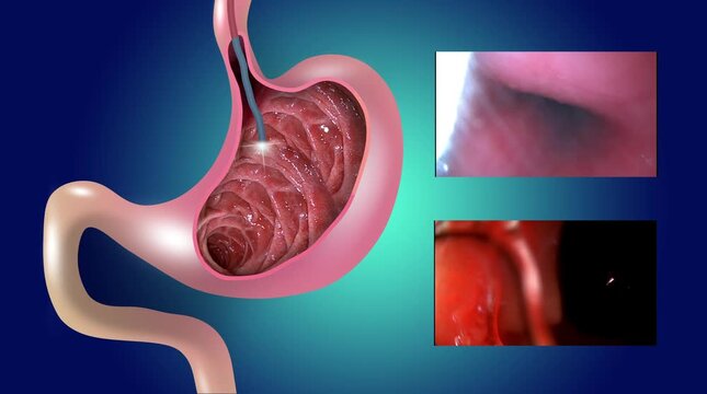 2D animation. Gastric mucosa. Digestive endoscopy or gastroscopy. Performing a gastroscopy procedure. Diagnostics of gastric diseases. Stomach health. Medical concept