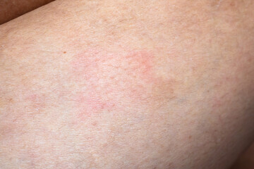 Skin allergy rash dermatitis texture close up