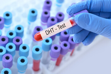 Doctor holding a test blood sample tube with DHT hormone test on the background of medical test tubes with analyzes.