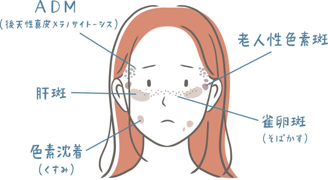 シミの種類と女性の顔のイラスト素材