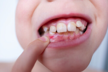 close-up teeth of child, boy 10 years old points new tooth fang in mouth with finger, concept...
