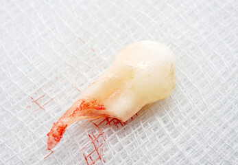 Close-up of tooth that had just been extracted had red blood stains stuck to the tooth root, Tooth extraction concept, macro.
