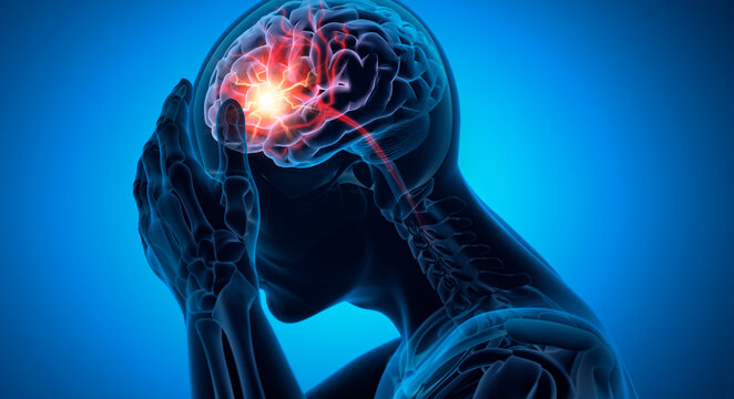 Man with a headache -  Brain Stroke - 3D Illustration