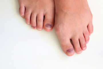Bruised toenail after hiking, injured nails on foot