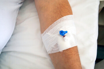 A male arm with a ready intravenous line before the surgery