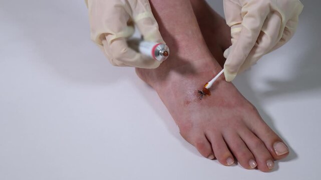 post-surgical incision is meticulously cared for as a healthcare provider applies a topical ointment to promote quicker wound healing.